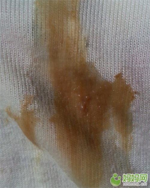 赠卵私立供卵试管因胚胎质量差而失败，是女方的锅还是男方的锅？