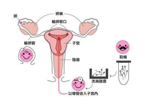 所有的不孕不育都可以人工试管代怀费用详解吗？